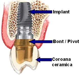 Implant si bont protetic